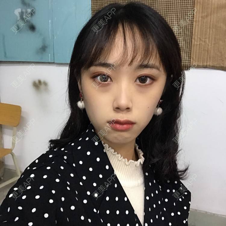 更美 - 王艳 医生的双眼皮经验 | 嘉兴 | 双眼皮