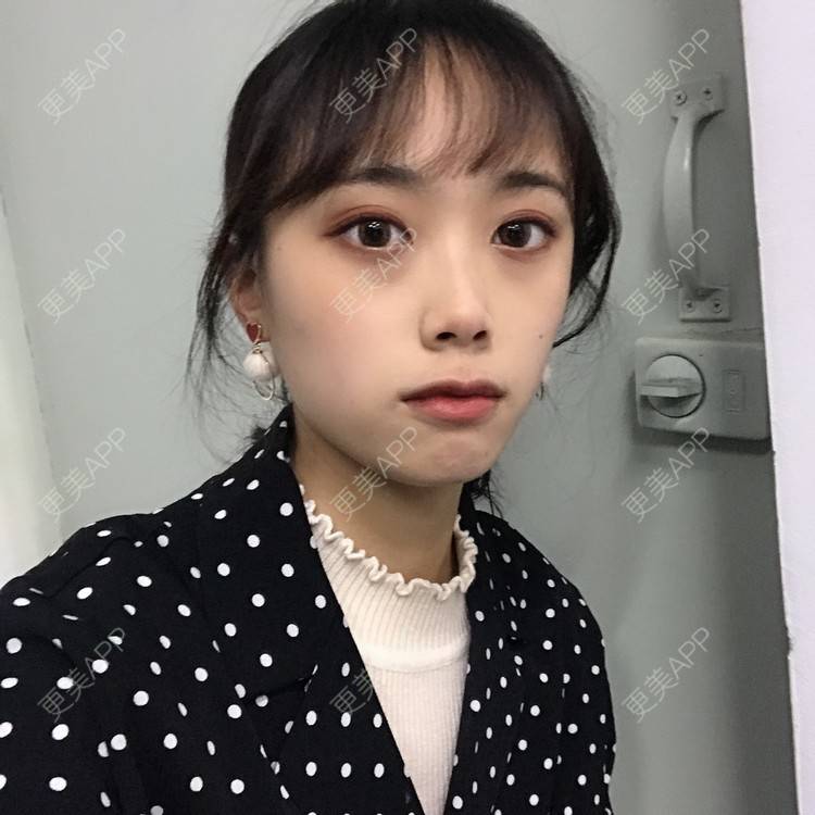 更美 - 王艳 医生的双眼皮经验 | 嘉兴 | 双眼皮