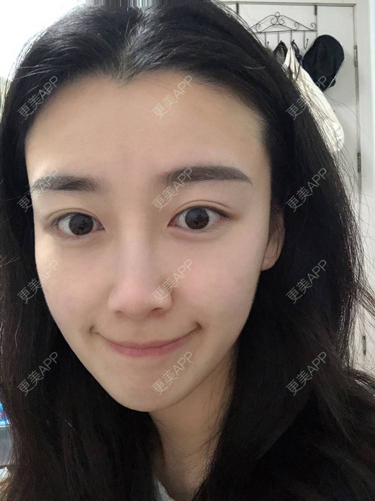 更美 - 范萌知 医生的隆鼻经验 | 隆鼻 | 嘉兴