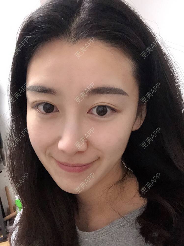 更美 - 范萌知 医生的隆鼻经验 | 隆鼻 | 嘉兴
