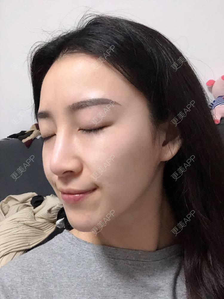 更美 - 范萌知 医生的隆鼻经验 | 隆鼻 | 嘉兴