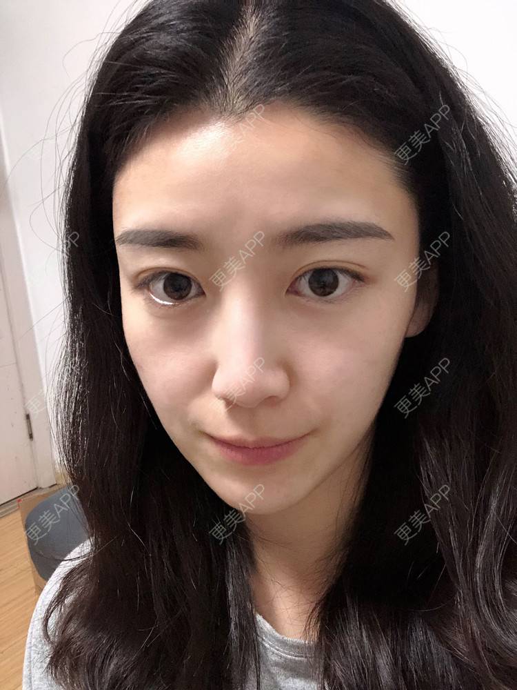 更美 - 范萌知 医生的隆鼻经验 | 隆鼻 | 嘉兴