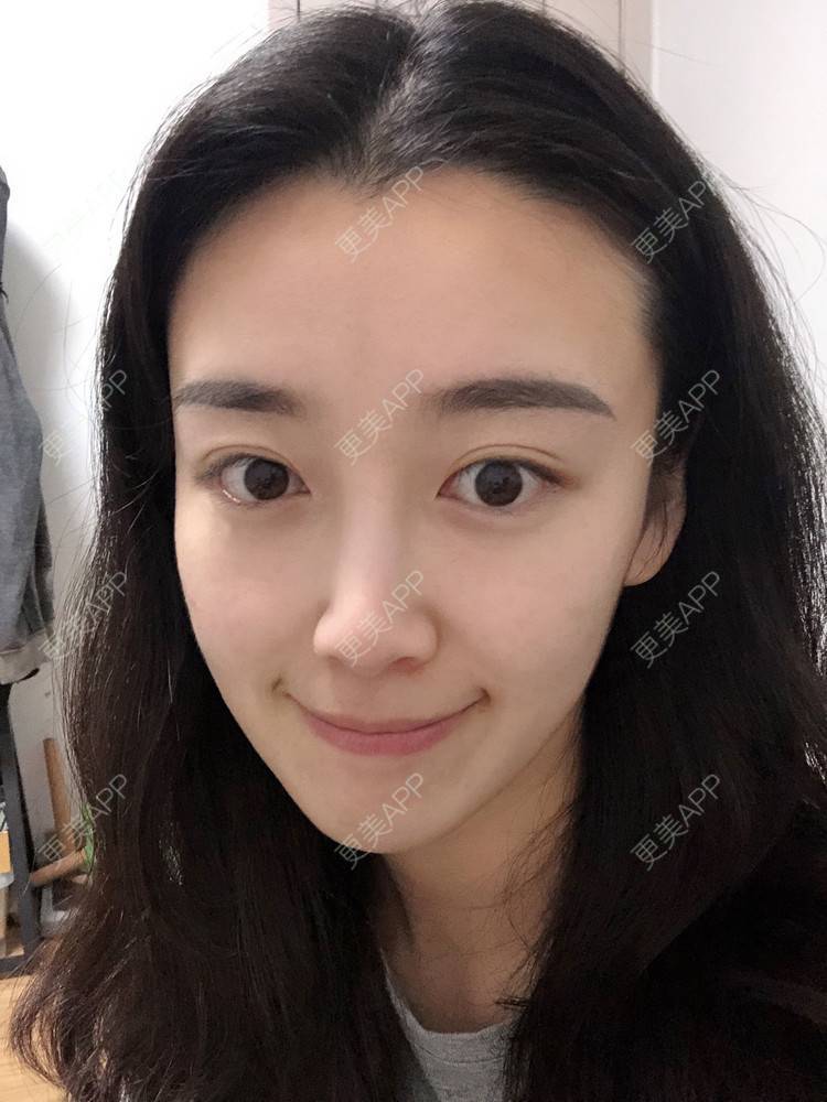 更美 - 范萌知 医生的隆鼻经验 | 隆鼻 | 嘉兴