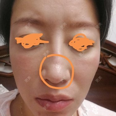 鼻中隔软骨隆鼻