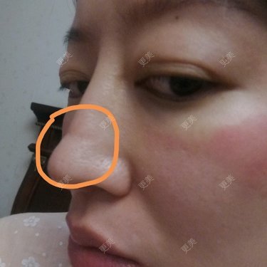 鼻中隔软骨隆鼻