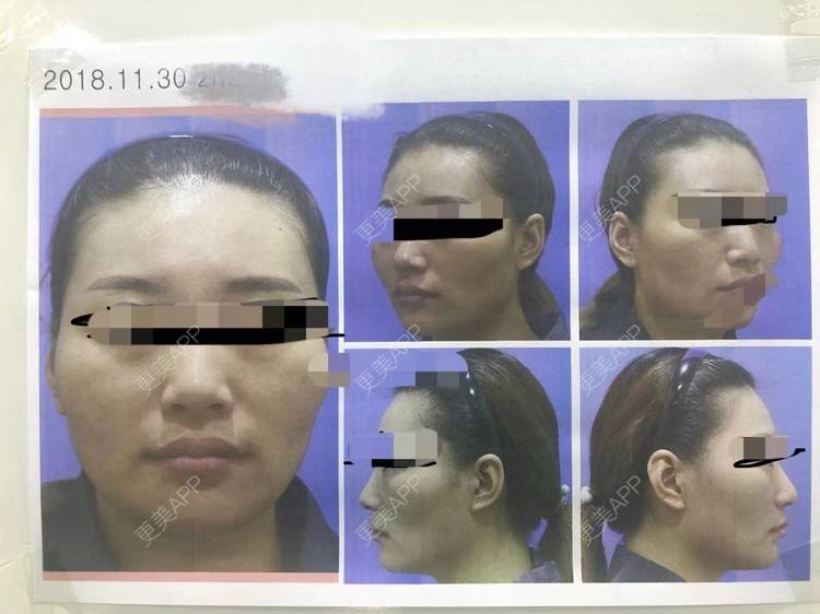 更美 - 更美用户VHj5R052qm的轮廓套餐经验 | 面部不对称矫正 | 轮廓套餐