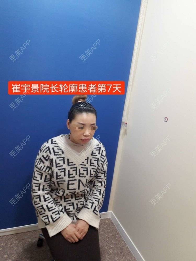 更美 - 更美用户VHj5R052qm的轮廓套餐经验 | 面部不对称矫正 | 轮廓套餐