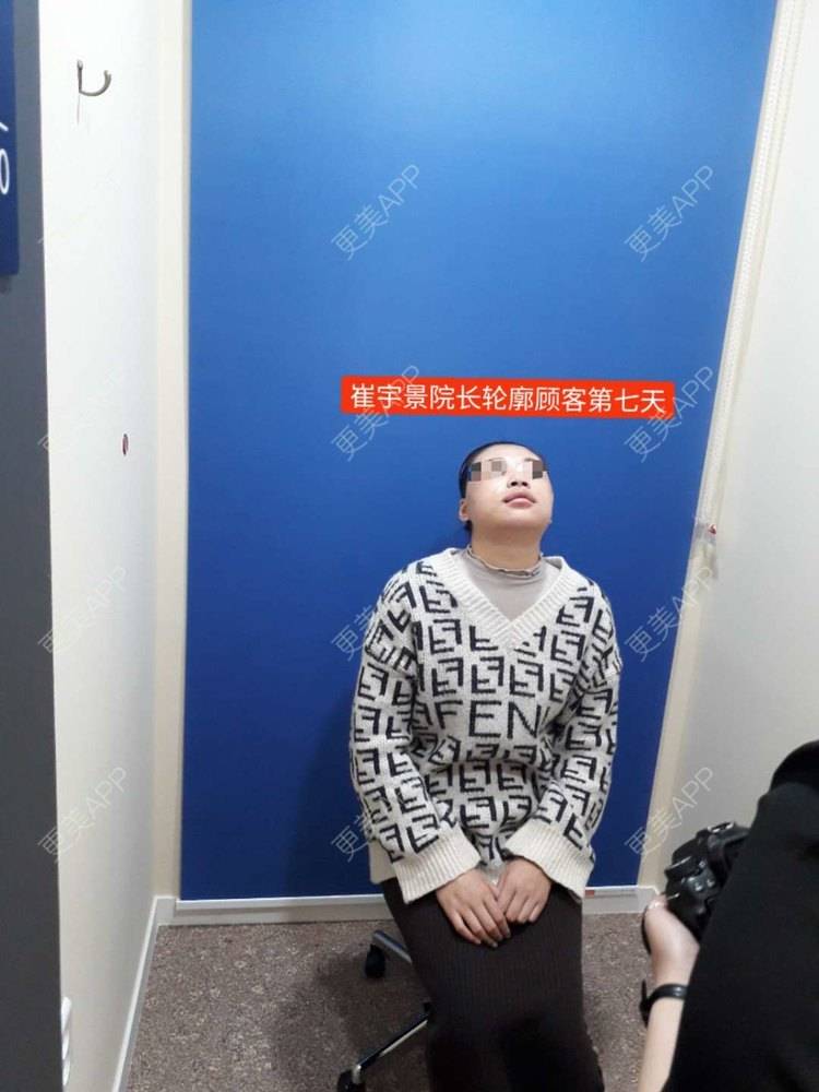 更美 - 更美用户VHj5R052qm的轮廓套餐经验 | 面部不对称矫正 | 轮廓套餐