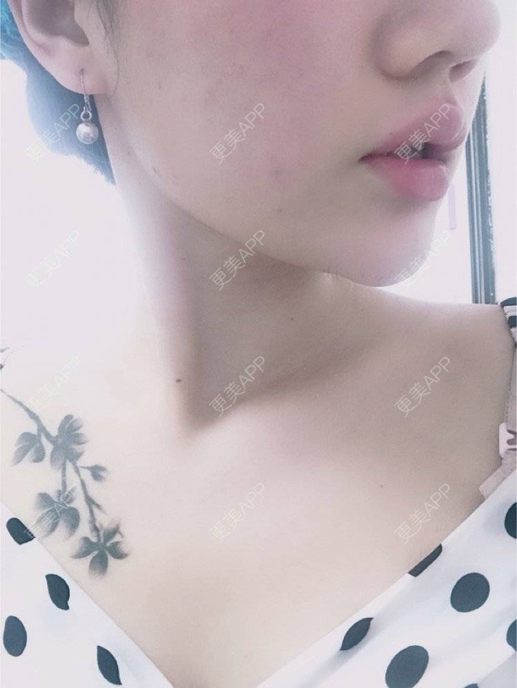 更美 - Kaleidoscope.的玻尿酸经验 | 注射美肤 | 热玛吉 | 女性私密检查 | 北京 | 清洁水光补水 | 昆明 | 吸脂瘦大腿 | 大连 | 上海 | 西安 | 武汉 | 玻尿酸下巴 | 吸脂 | 南京 | 玻尿酸