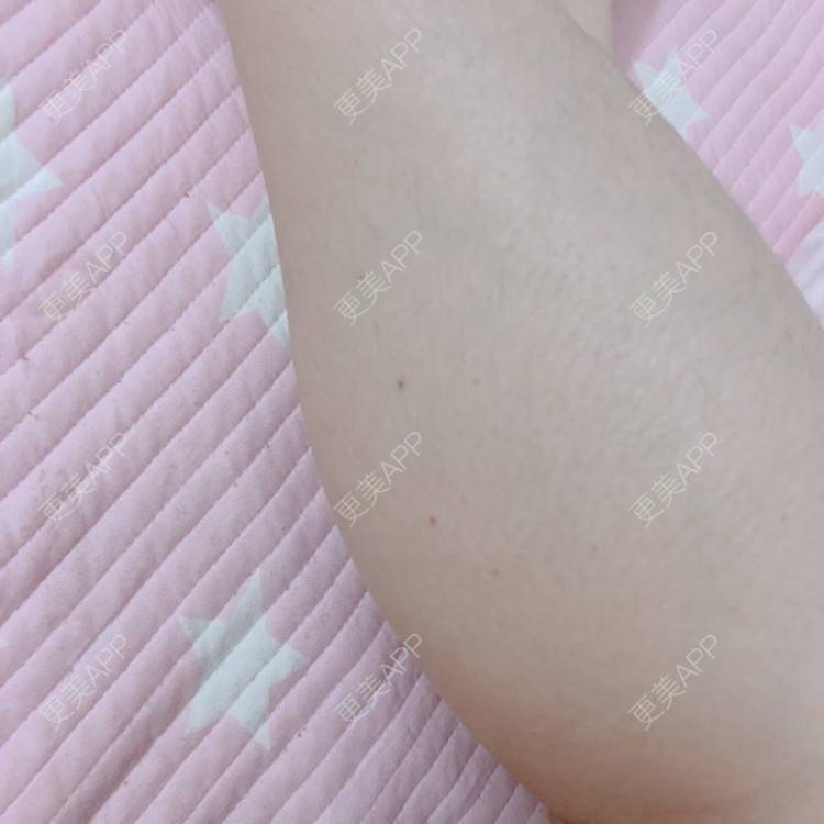 更美 - cing的注射塑形腿部经验 | 注射美肤 | 女性私密检查 | 清洁水光补水 | 吸脂 | 玻尿酸 | 注射塑形腿部 | 吸脂瘦大腿 | 热玛吉 | 皮秒激光 | 玻尿酸下巴 | 深圳