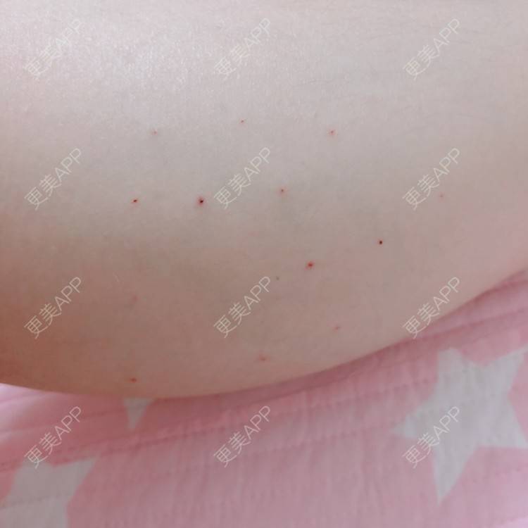 更美 - cing的注射塑形腿部经验 | 注射美肤 | 女性私密检查 | 清洁水光补水 | 吸脂 | 玻尿酸 | 注射塑形腿部 | 吸脂瘦大腿 | 热玛吉 | 皮秒激光 | 玻尿酸下巴 | 深圳