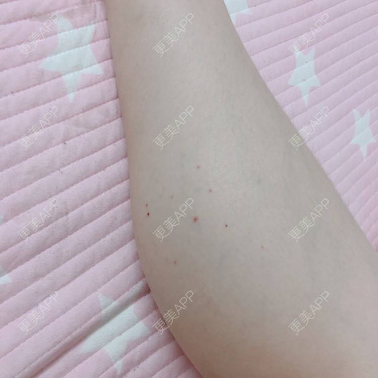 更美 - cing的注射塑形腿部经验 | 注射美肤 | 女性私密检查 | 清洁水光补水 | 吸脂 | 玻尿酸 | 注射塑形腿部 | 吸脂瘦大腿 | 热玛吉 | 皮秒激光 | 玻尿酸下巴 | 深圳