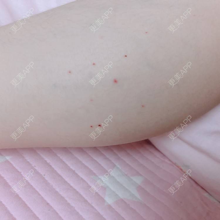 更美 - cing的注射塑形腿部经验 | 注射美肤 | 女性私密检查 | 清洁水光补水 | 吸脂 | 玻尿酸 | 注射塑形腿部 | 吸脂瘦大腿 | 热玛吉 | 皮秒激光 | 玻尿酸下巴 | 深圳