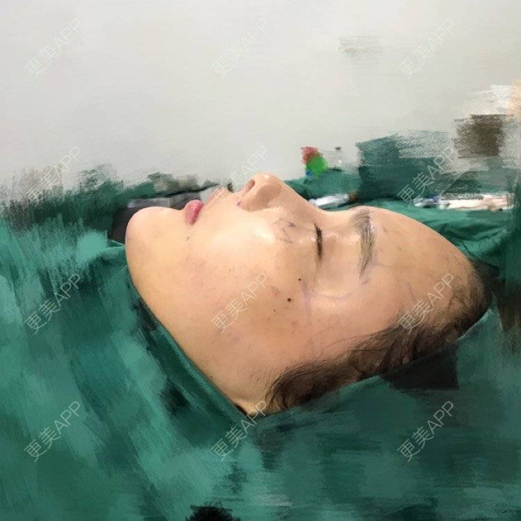 更美 - 小辛星的自体脂肪丰苹果肌经验 | 自体脂肪丰苹果肌 | 自体脂肪垫下巴 | 自体脂肪丰太阳穴 | 自体脂肪丰额头 | 杭州 | 自体脂肪全面部填充