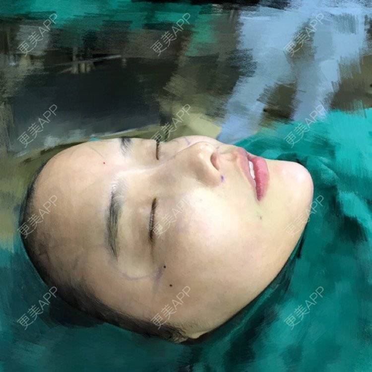 更美 - 小辛星的自体脂肪丰苹果肌经验 | 自体脂肪丰苹果肌 | 自体脂肪垫下巴 | 自体脂肪丰太阳穴 | 自体脂肪丰额头 | 杭州 | 自体脂肪全面部填充