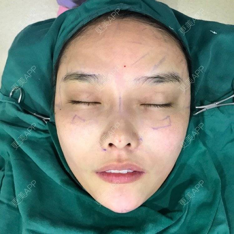 更美 - 小辛星的自体脂肪丰苹果肌经验 | 自体脂肪丰苹果肌 | 自体脂肪垫下巴 | 自体脂肪丰太阳穴 | 自体脂肪丰额头 | 杭州 | 自体脂肪全面部填充