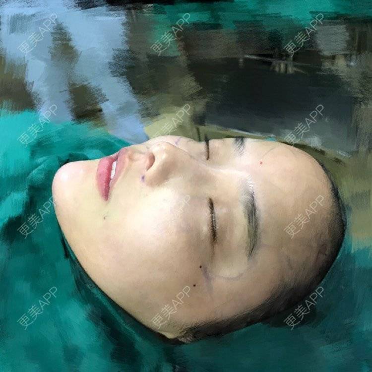 更美 - 小辛星的自体脂肪丰苹果肌经验 | 自体脂肪丰苹果肌 | 自体脂肪垫下巴 | 自体脂肪丰太阳穴 | 自体脂肪丰额头 | 杭州 | 自体脂肪全面部填充