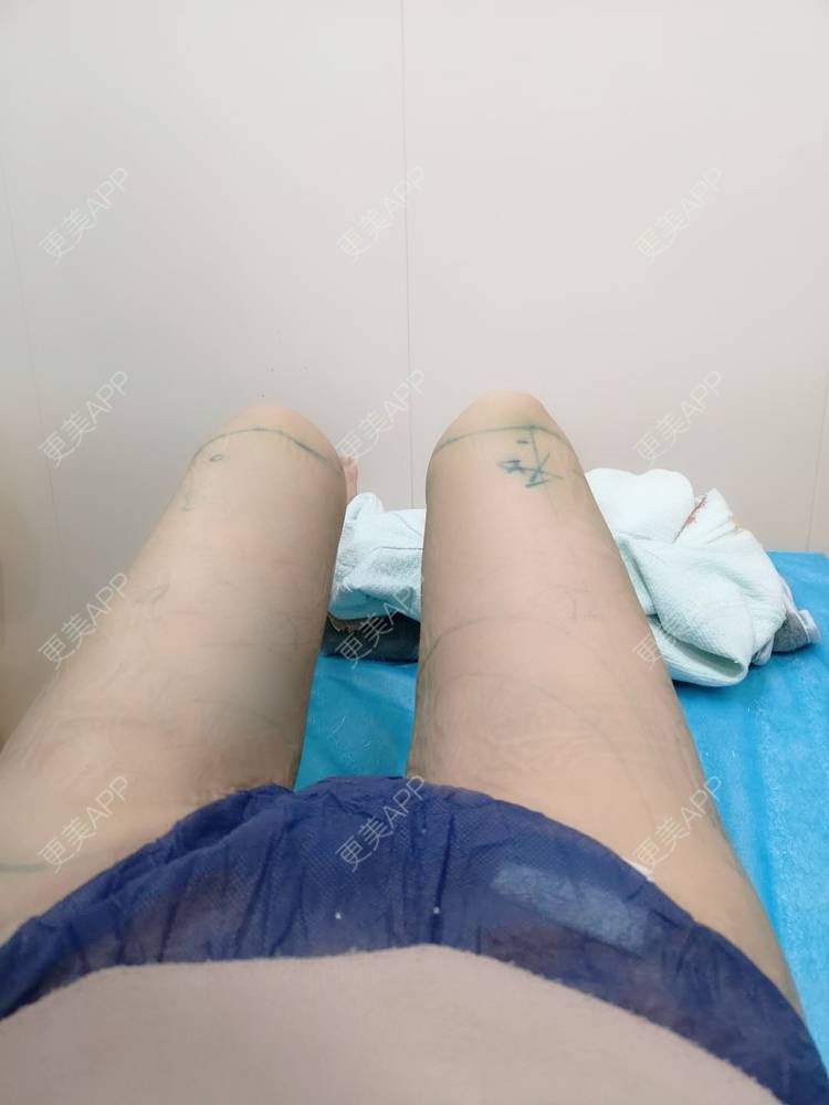 更美 - 玫瑰園的百合🌼的吸脂瘦大腿经验 | 吸脂塑臀 | 吸脂瘦大腿