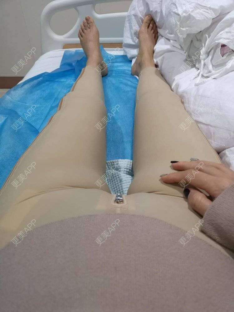 更美 - 玫瑰園的百合🌼的吸脂瘦大腿经验 | 吸脂塑臀 | 吸脂瘦大腿