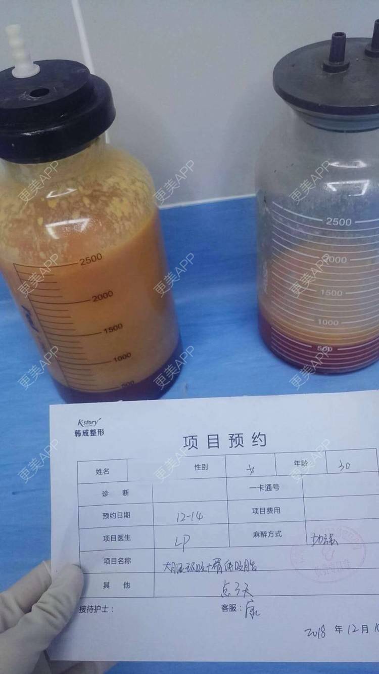 更美 - 玫瑰園的百合🌼的吸脂瘦大腿经验 | 吸脂塑臀 | 吸脂瘦大腿
