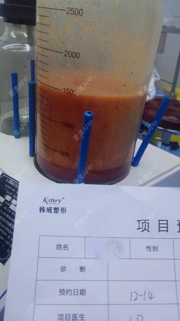 更美 - 玫瑰園的百合🌼的吸脂瘦大腿经验 | 吸脂塑臀 | 吸脂瘦大腿