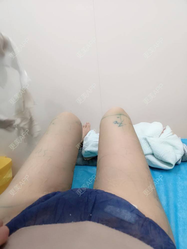 更美 - 玫瑰園的百合🌼的吸脂瘦大腿经验 | 吸脂塑臀 | 吸脂瘦大腿