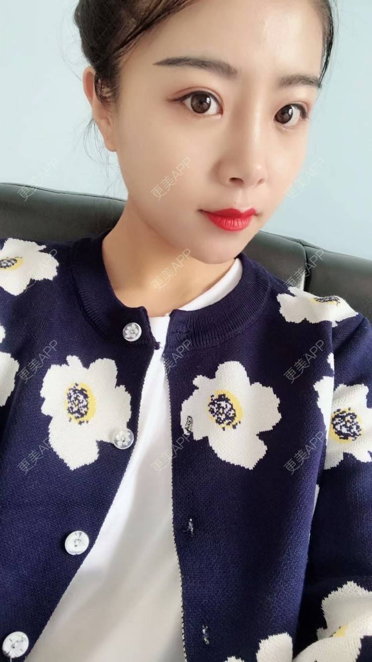 更美 - 覃新月 医生的水光项目经验 | 水光项目 | 南宁