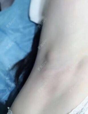 更美 - 覃新月 医生的激光脱毛经验 | 视频日记 | 南宁 | 激光脱毛