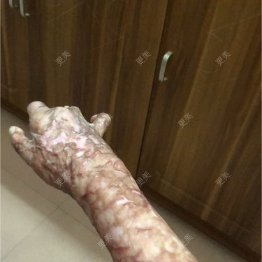 烫伤后植皮的皮肤留下疤痕而且和原来的皮肤颜色不同怎么办