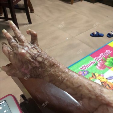 烫伤后植皮的皮肤留下疤痕而且和原来的皮肤颜色不同怎么办