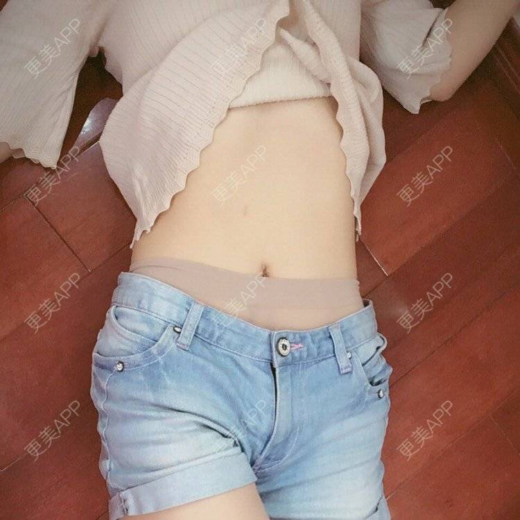 更美 - 好好心情的腰腹吸脂经验 | 腰腹吸脂 | 背部吸脂 | 吸脂瘦大腿 | 手臂吸脂 | 杭州