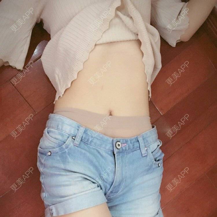 更美 - 好好心情的腰腹吸脂经验 | 腰腹吸脂 | 背部吸脂 | 吸脂瘦大腿 | 手臂吸脂 | 杭州