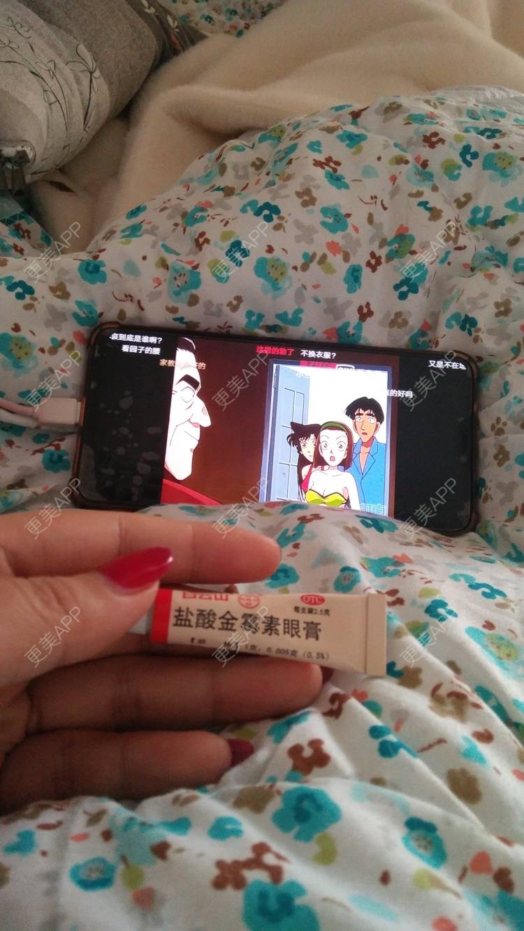 更美 - 红薯冰的祛眼袋经验 | 祛眼袋 | 开外眼角 | 外切去眼袋 | 自体脂肪填充泪沟 | 深圳