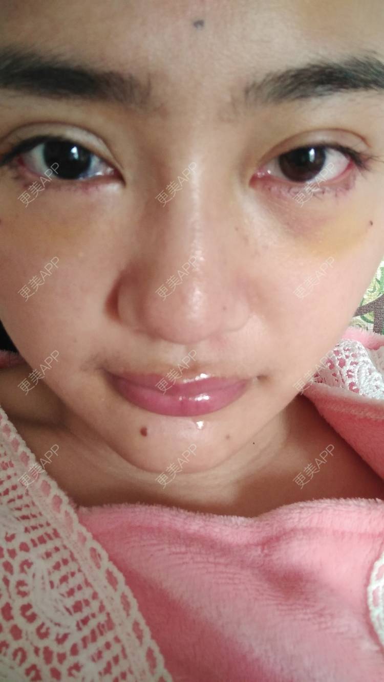 更美 - 红薯冰的祛眼袋经验 | 祛眼袋 | 开外眼角 | 外切去眼袋 | 自体脂肪填充泪沟 | 深圳