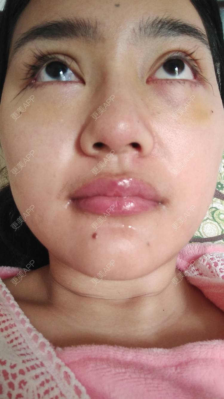 更美 - 红薯冰的祛眼袋经验 | 祛眼袋 | 开外眼角 | 外切去眼袋 | 自体脂肪填充泪沟 | 深圳