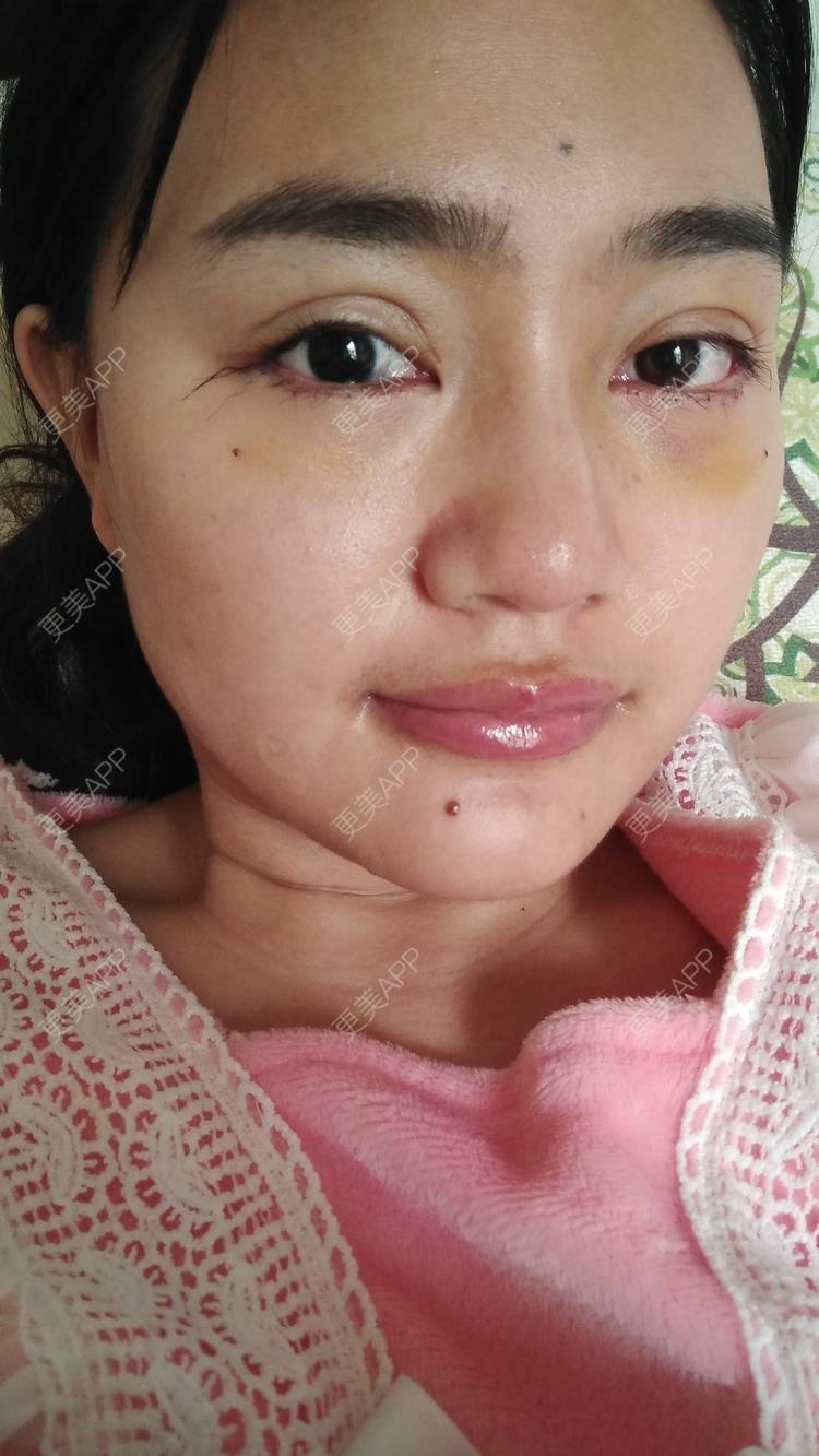 更美 - 红薯冰的祛眼袋经验 | 祛眼袋 | 开外眼角 | 外切去眼袋 | 自体脂肪填充泪沟 | 深圳