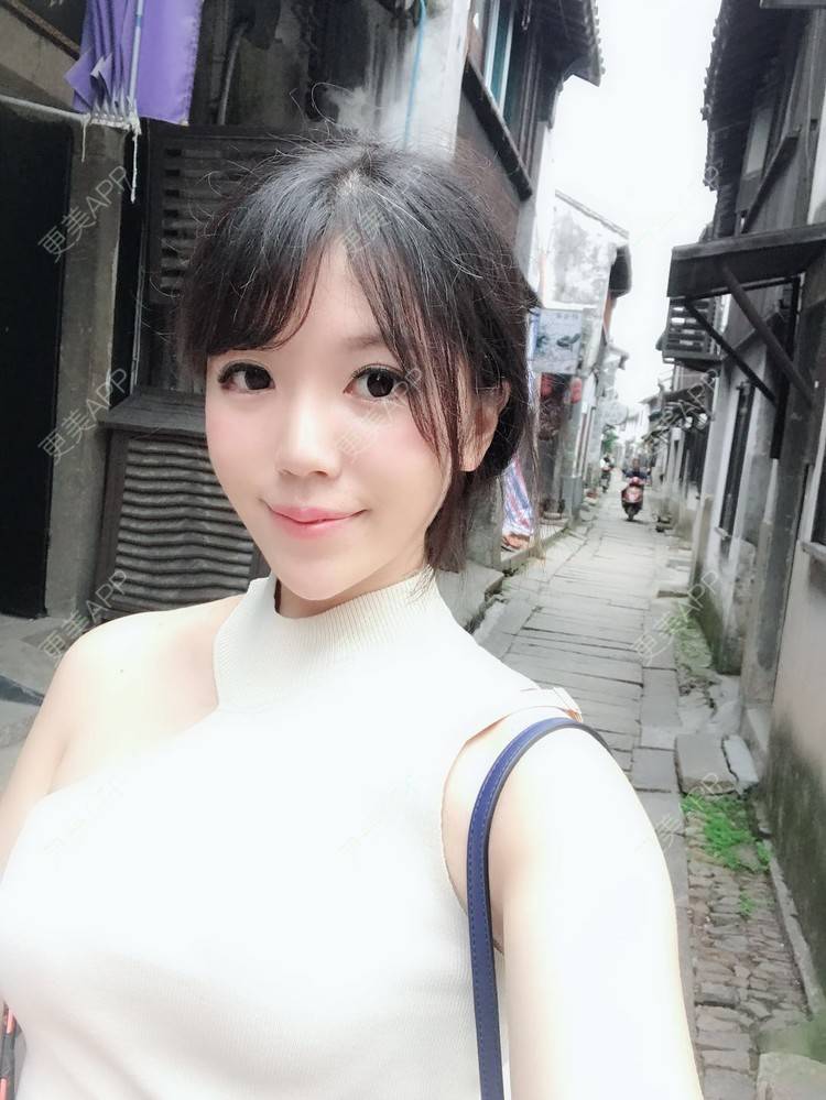 更美 - 张书毓 医生的自体脂肪全面部填充经验 | 自体脂肪全面部填充 | 沈阳 | 视频日记