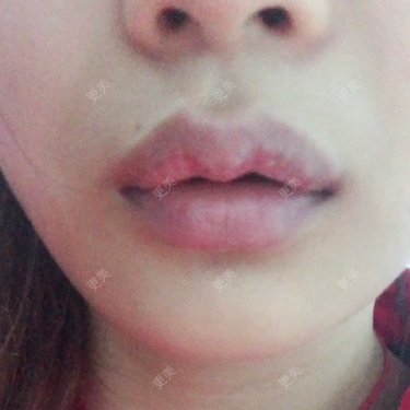 厚唇改薄