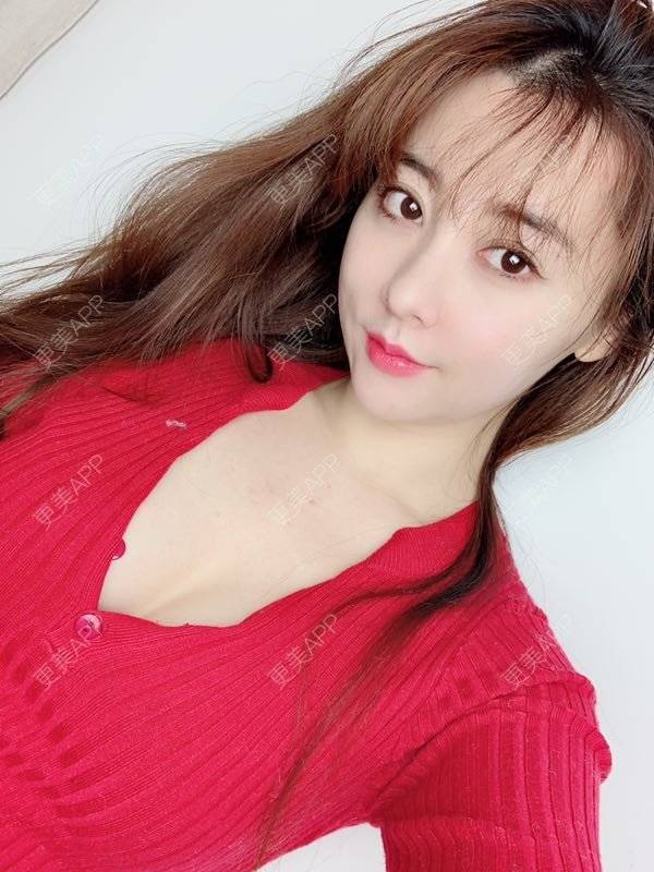 流星雨fome的丰胸(隆胸)日记 | 自体脂肪隆胸 | 视频日记 | 乳房再造