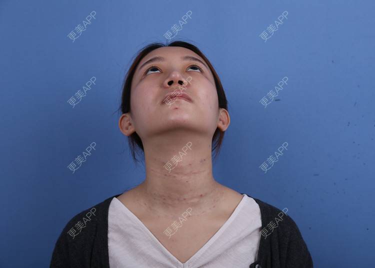 更美 - 瑶瑶就要瑶瑶的颈部经验 | 广州 | 玻尿酸颈纹 | 颈部