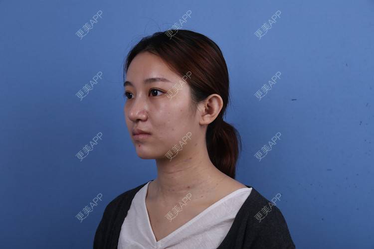 更美 - 瑶瑶就要瑶瑶的颈部经验 | 广州 | 玻尿酸颈纹 | 颈部