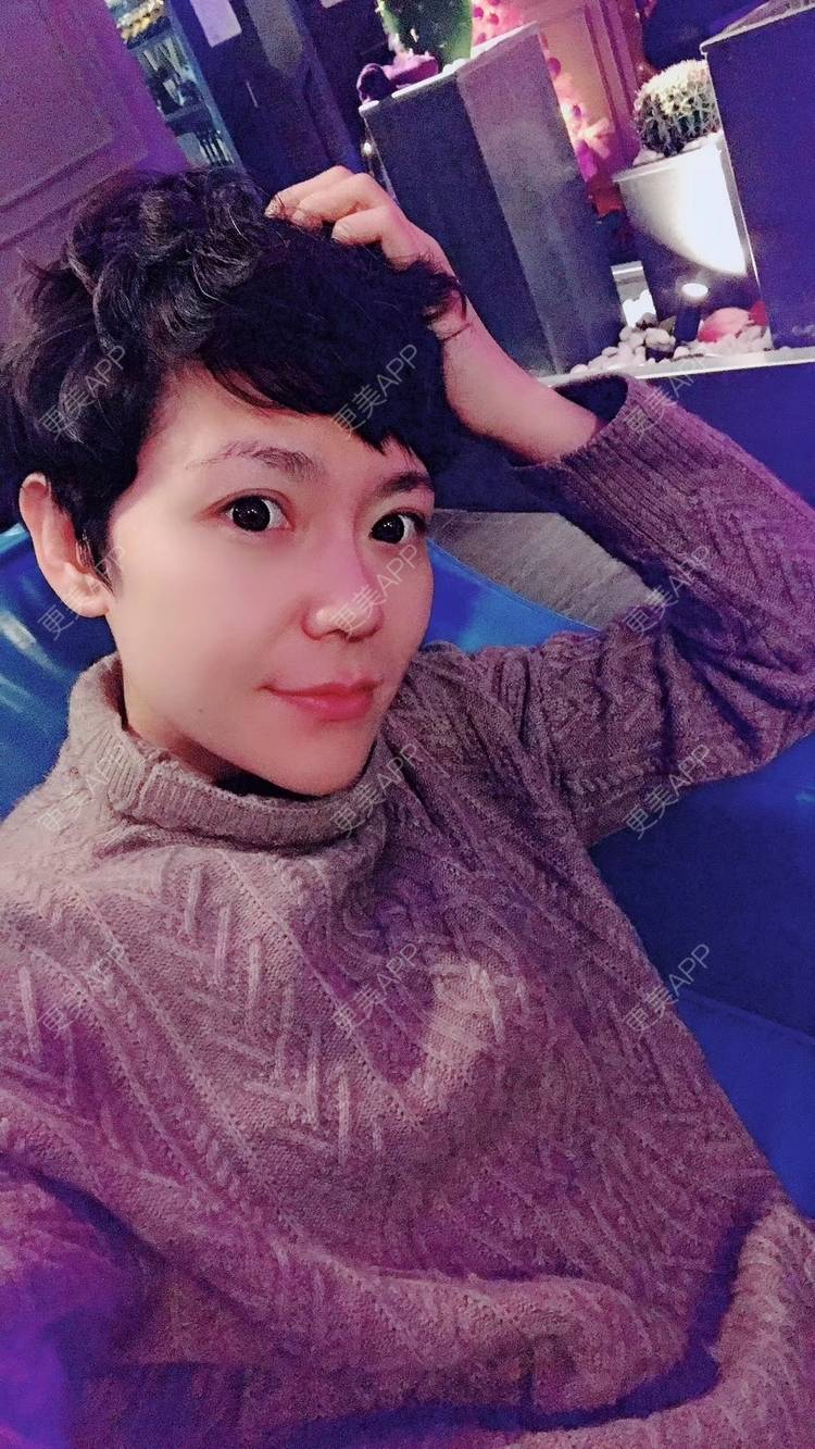更美 - 鞍山铁东区张玉霞星范医疗美容门诊部的埋线隆鼻经验 | 埋线隆鼻