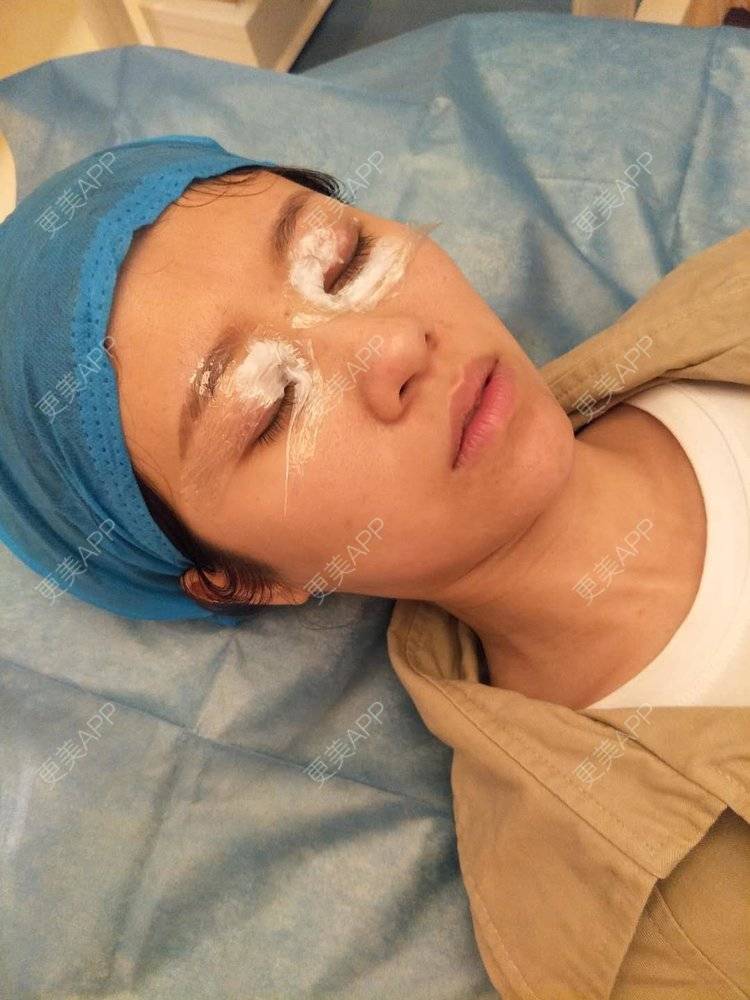 更美 - 更美用户qFi8xuX6UQ的激光去脂肪粒经验 | 激光去脂肪粒