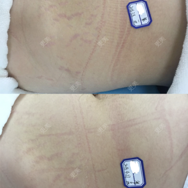 纳米微晶淡化妊娠纹/肥胖纹/生长纹 (腰部单次)#深圳2018-07-06峡目