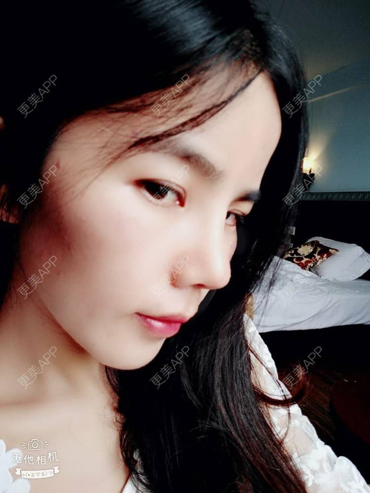 更美 - 张翎 医生的硅胶隆鼻经验 | 硅胶隆鼻 | 南宁