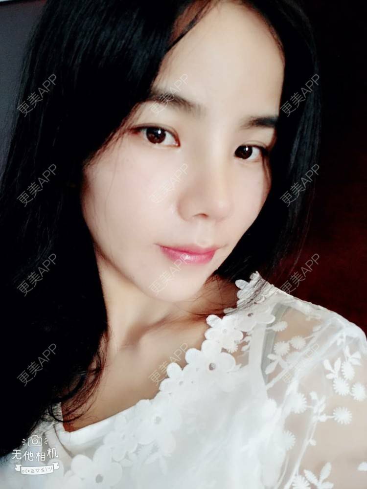 更美 - 张翎 医生的硅胶隆鼻经验 | 硅胶隆鼻 | 南宁
