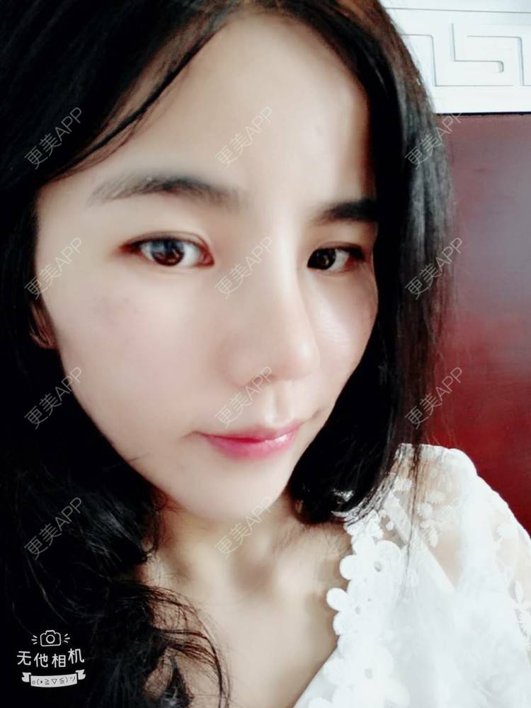 更美 - 张翎 医生的硅胶隆鼻经验 | 硅胶隆鼻 | 南宁