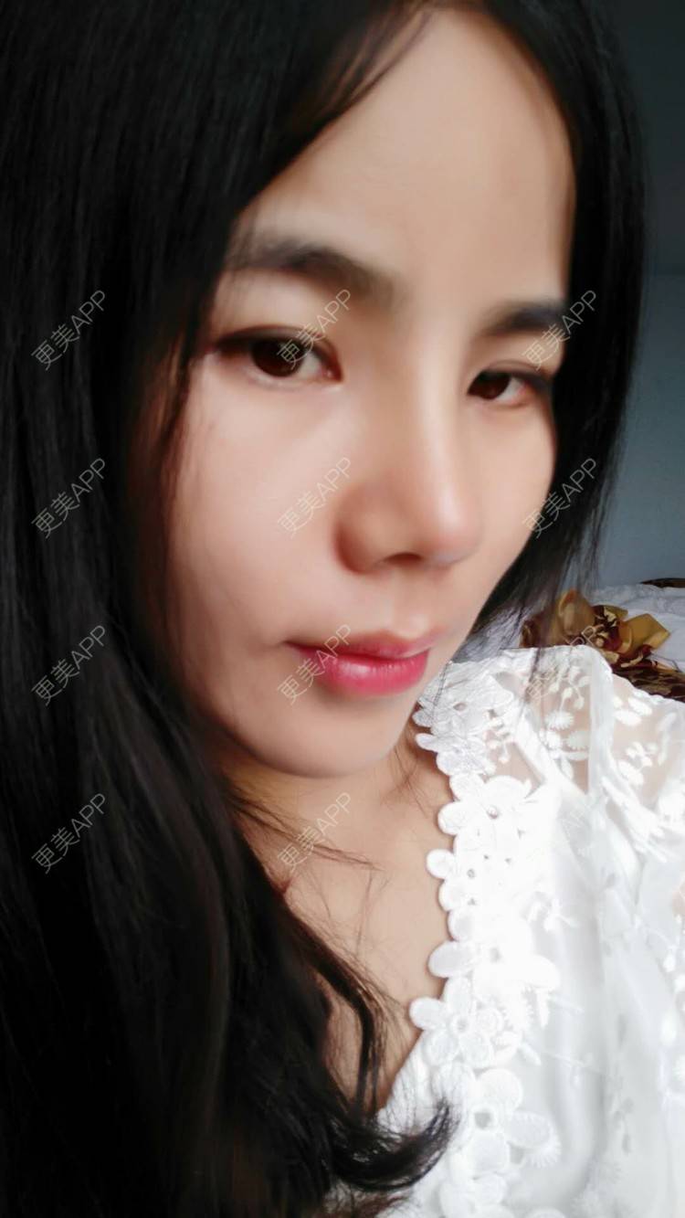 更美 - 张翎 医生的硅胶隆鼻经验 | 硅胶隆鼻 | 南宁
