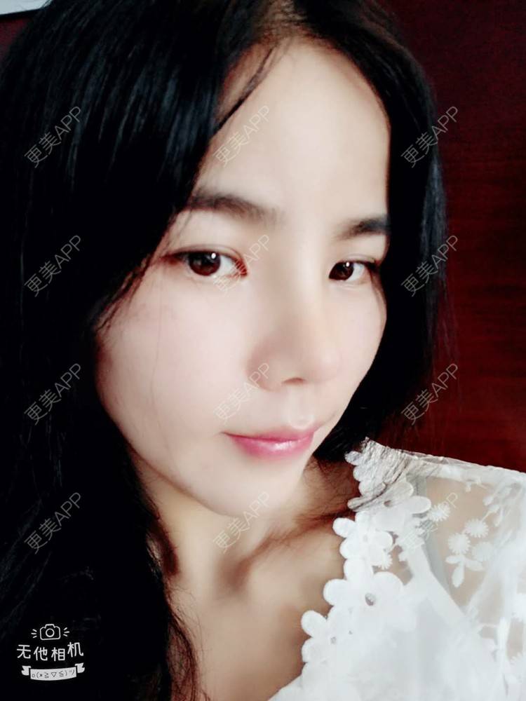 更美 - 张翎 医生的硅胶隆鼻经验 | 硅胶隆鼻 | 南宁