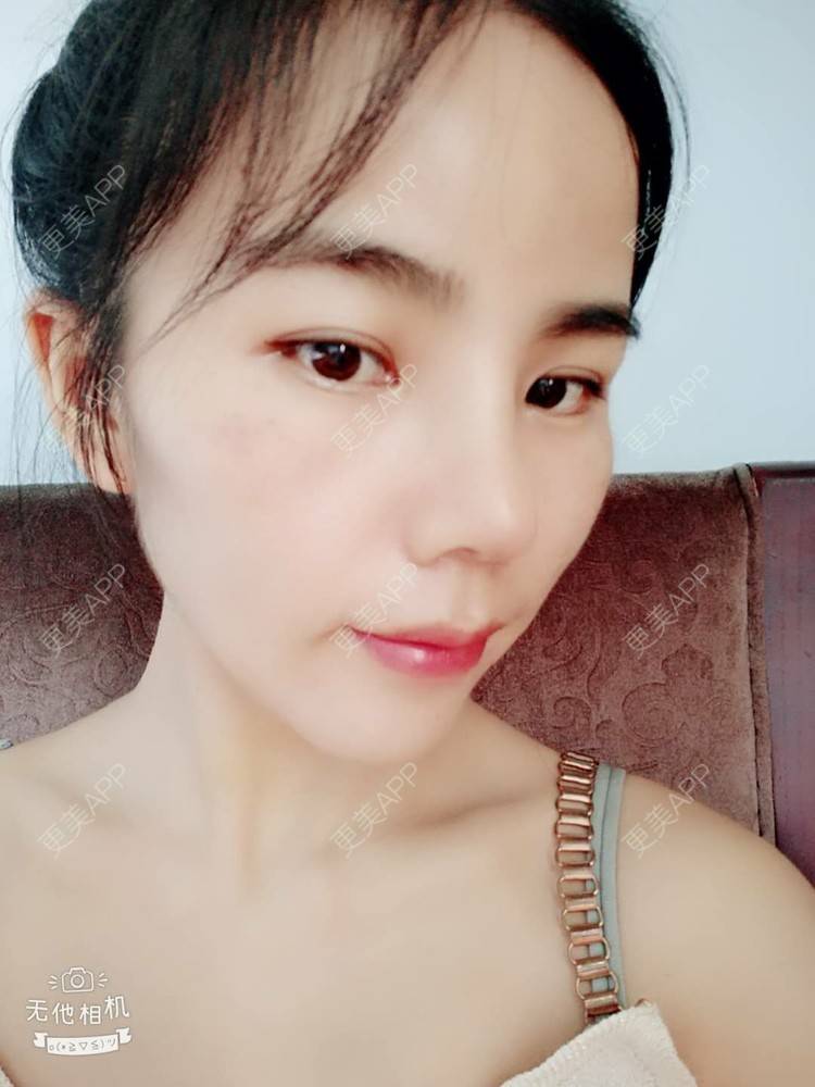 更美 - 张翎 医生的硅胶隆鼻经验 | 硅胶隆鼻 | 南宁